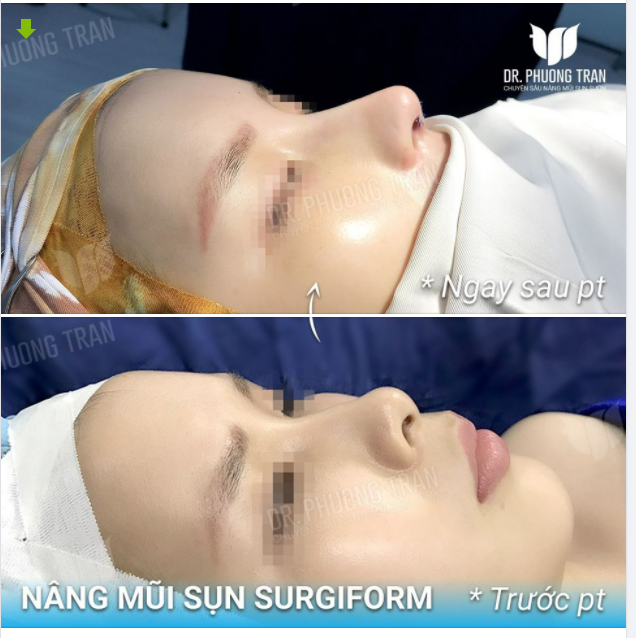 “THẢ NHẸ” CHIẾC ẢNH NÂNG MŨI ĐẶT SỐNG CHỤP VỘI