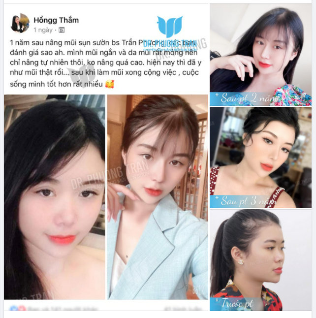 THẦN SẮC SÁNG BỪNG SAU 2 NĂM NÂNG MŨI SỤN SƯỜN