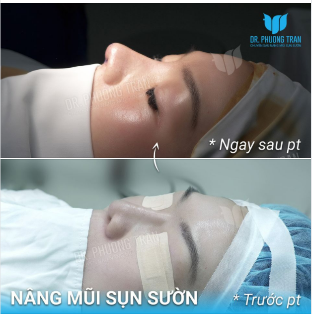 THẬT SỰ RUNG ĐỘNG VỚI CHIẾC MŨI SỤN SƯỜN NÀY