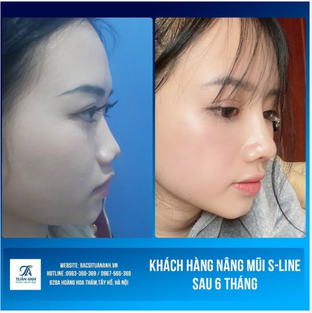 THAY ĐỔI THẦN THÁI - CHỈ VỚI 40P NÂNG MŨI S-LINE GIẢM NGAY 25% đến hết 20/10.