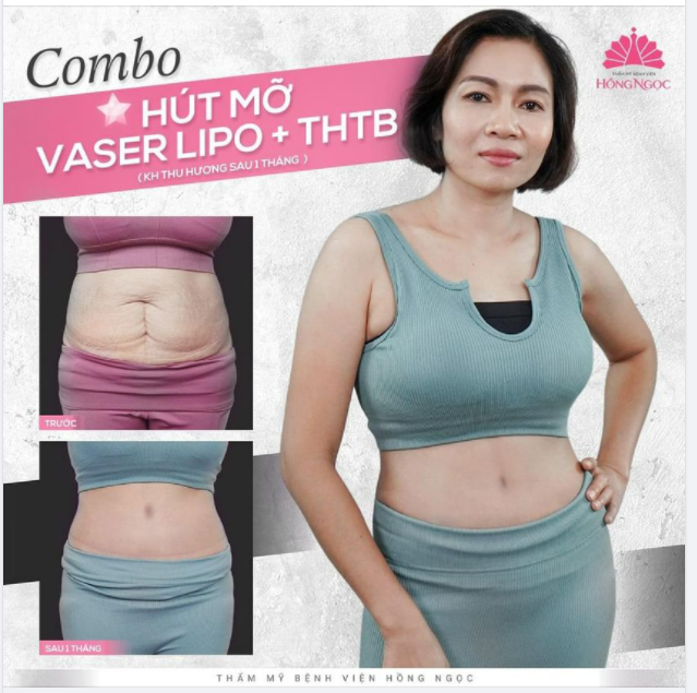 THÊM 1 KHÁCH HÀNG VỀ DÁNG THÀNH CÔNG VỚI COMBO ''HÚT MỠ + TẠO HÌNH THÀNH BỤNG'' TẠI HỒNG NGỌC: