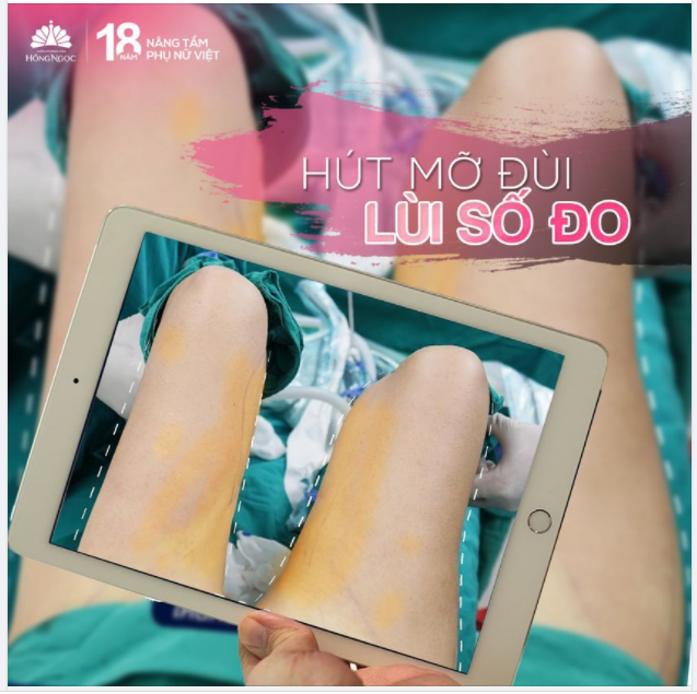 THOÁT KIẾP ''ĐÙI ẾCH'', ''CHÂN THÔ'' CHỈ SAU 30P THỰC HIỆN