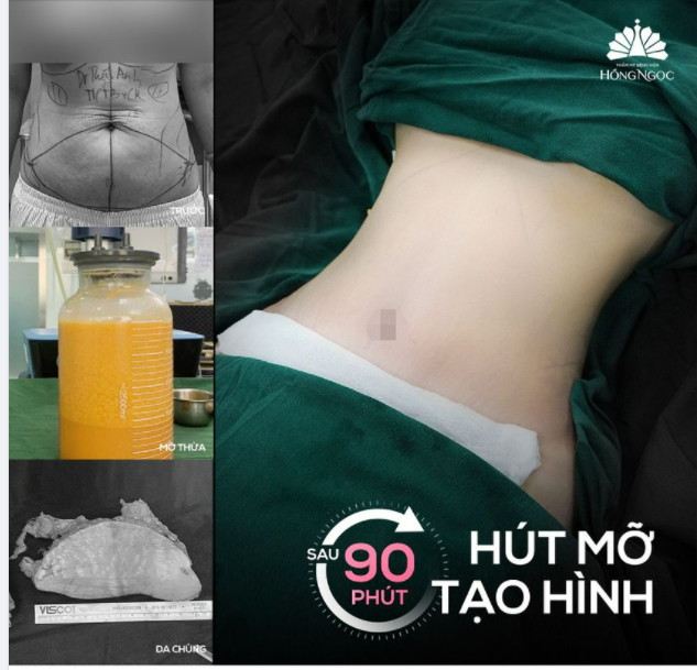 THOÁT XÁC MẸ SỀ - EO VỀ MINHON VỚI COMBO HÚT MỠ TẠO HÌNH