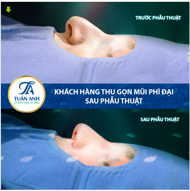 THU GỌN MŨI PHÌ ĐẠI - KIẾN TẠO DÁNG MŨI PURI- FORM