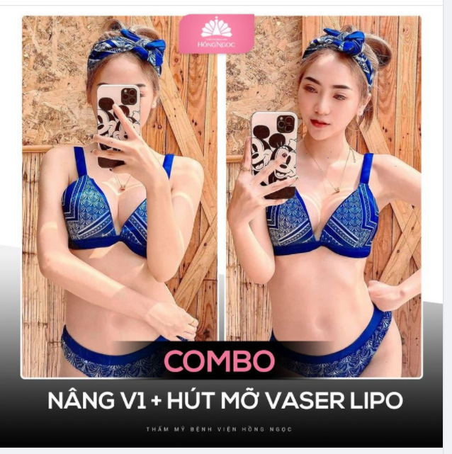 THỰC HIỆN COMBO NÂNG V1 + HÚT MỠ NÊN HAY KHÔNG?