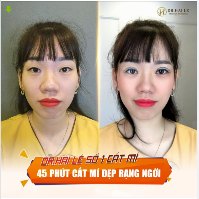 TOP 3 LÝ DO NÊN CHỌN CẮT MÍ TẠI DR.HẢI LÊ