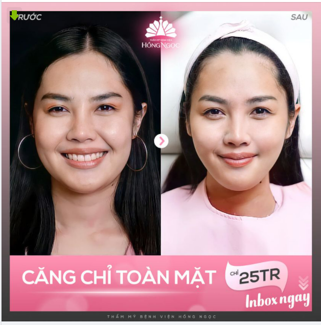TRĂM NGHE KHÔNG BẰNG MỘT THẤY! Xem ngay màn "hack tuổi" cực đỉnh của chị khách 45 tuổi sau 60p căng chỉ Younger Lifting Fiber tại Hồng Ngọc dưới đây nhé!