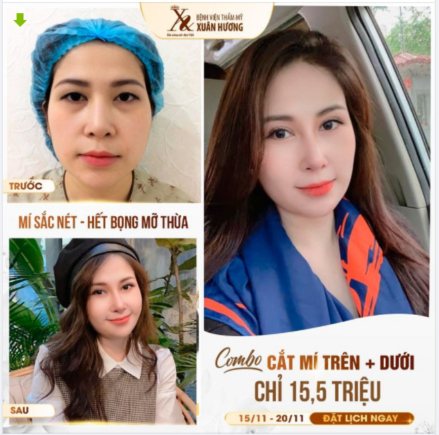 TRẺ HÓA KHUÔN MẮT TOÀN DIỆN - XÓA BỎ MỌI KHUYẾT ĐIỂM THẨM MỸ MẮT NHỜ COMBO CẮT MÍ TRÊN + DƯỚI TẠI BVTM XUÂN HƯƠNG