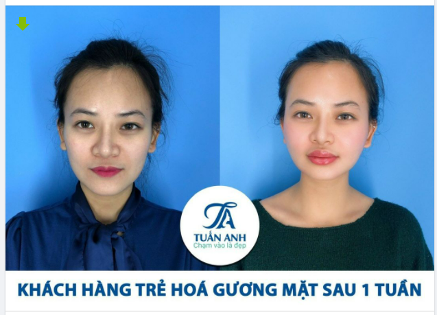 TRẺ HOÁ VÙNG MÁ BẰNG MỠ TỰ THÂN