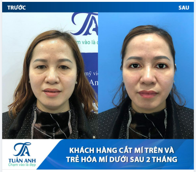 Trẻ ra 10 tuổi sau khi làm combo dịch vụ CẮT MÍ TRÊN + TRẺ HÓA MÍ DƯỚI cùng ekip Bác sĩ Tuấn Anh.