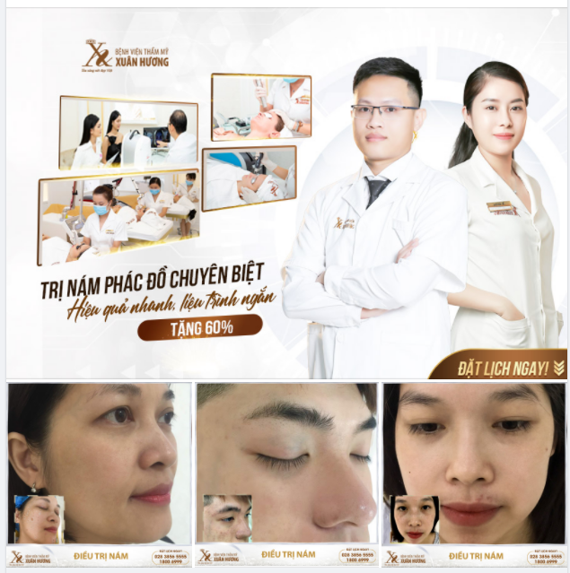 TRỊ NÁM CHUYÊN SÂU CÙNG BÁC SĨ - ĐÁNH BAY MỌI LOẠI NÁM CỨNG ĐẦU