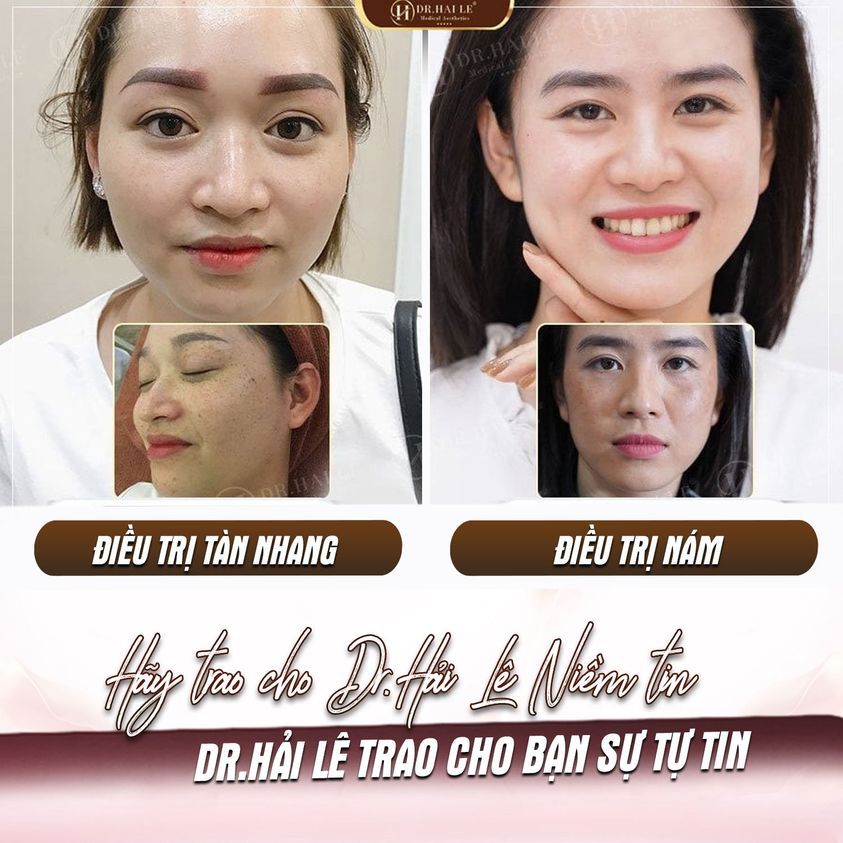 TRỊ NÁM, TÀN NHANG Ở ĐÂU HIỆU QUẢ VÀ AN TOÀN?