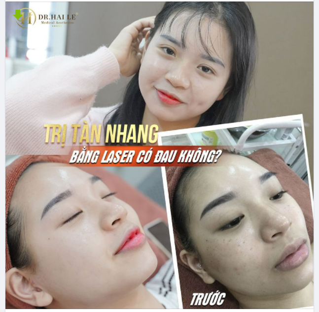 Trị tàn nhang bằng laser có đau không?