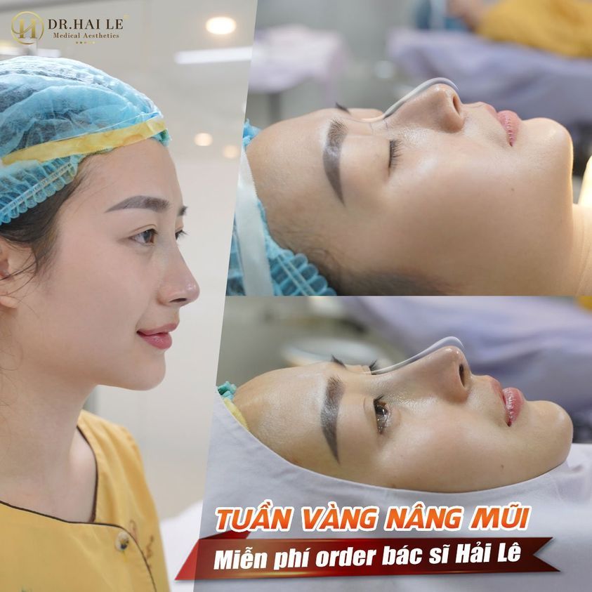 TUẦN VÀNG THẨM MỸ MŨI - MIỄN PHÍ CHI PHÍ ORDER BÁC SĨ HẢI LÊ.!!!