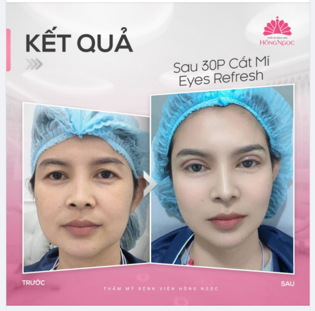 U40 HACK TUỔI NHƯ GÁI 30 SAU CẮT MÍ EYES REFRESH