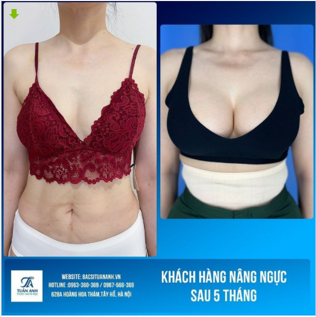 V1 Nano Chip Ergonomix bởi Bác sĩ Tuấn Anh - Ngực tự nhiên, đẹp xuất sắc phải không cả nhà