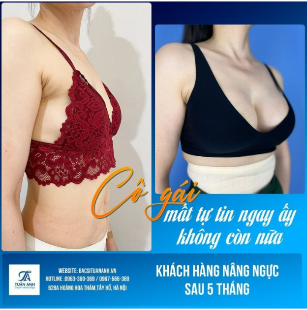 Vì sao độ loa bằng túi Nano chip Ergonomix tại thẩm mỹ TUẤN ANH được nhiều khách hàng lựa chọn