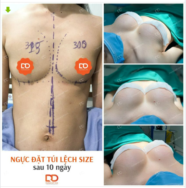 Với khách hàng 2 bên ngực không đều, bác sĩ sẽ đặt lệch size túi để cải thiện tình trạng và cho kết quả sau đẹp nhất có thể.