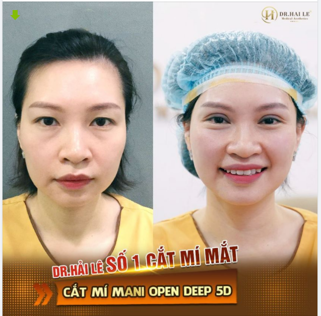 XINH TƯƠI, TRẺ TRUNG HƠN chỉ sau 30 phút CẮT MÍ MANI OPEN DEEP 5D