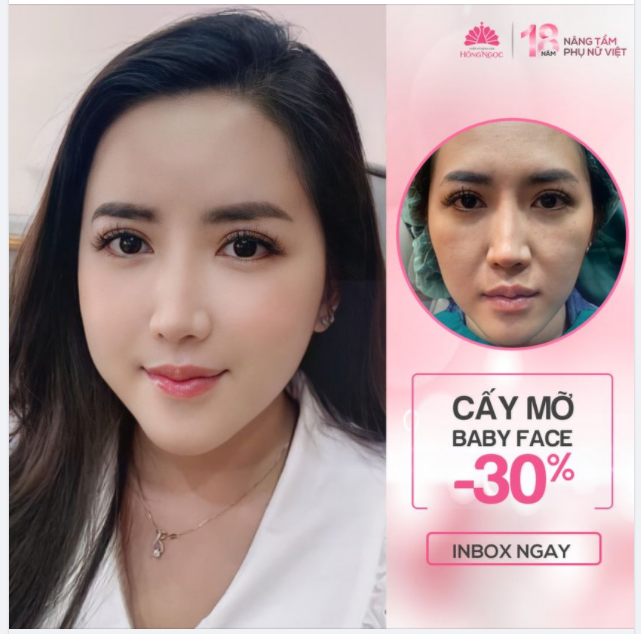 XÓA SẠCH GIÀ NUA - XUA TAN LÕM HÓP CHỈ SAU 60 PHÚT CẤY MỠ BABY FACE