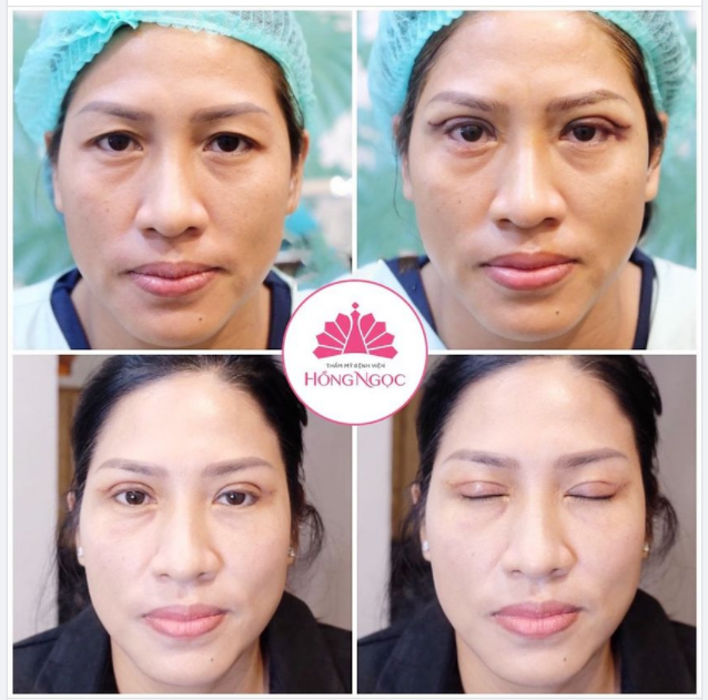 XÓA SỔ DA CHÙNG, BỌNG MỠ NHỜ CÔNG NGHỆ CẮT MÍ EYES REFESH