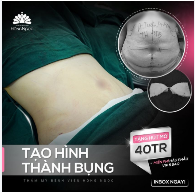 XÓA SỔ MỠ THỪA - DA CHÙNG - SẸO XẤU SAU SINH VỚI COMBO HÚT MỠ TẠO HÌNH