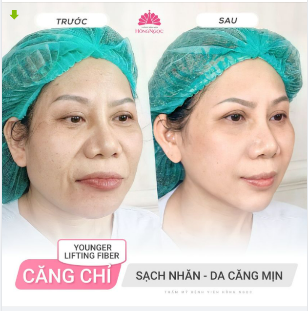XỬ LÝ ''GỌN NHẸ'' NẾP NHĂN, DA CHÙNG NHÃO VỚI CĂNG CHỈ YOUNGER LIFTING FIBER