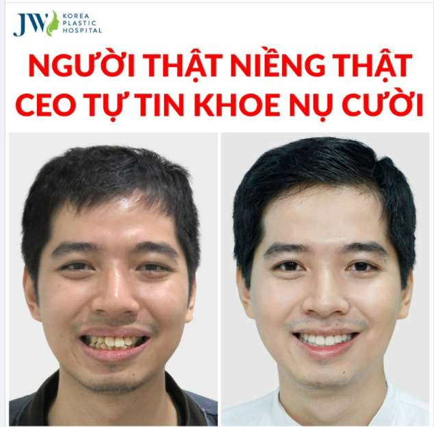30 TUỔI CÒN NIỀNG RĂNG ĐƯỢC KHÔNG?