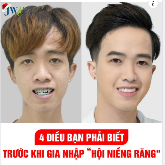 4 ĐIỀU BẠN PHẢI BIẾT TRƯỚC KHI GIA NHẬP “HỘI NIỀNG RĂNG"