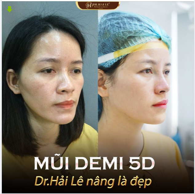 45 phút thực hiện - 10 ngày mũi vào form ổn định - 1 tháng mũi đẹp tự nhiên!