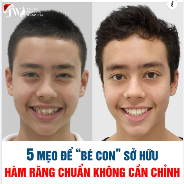 5 MẸO ĐỂ BÉ CON SỞ HỮU HÀM RĂNG CHUẨN KHÔNG CẦN CHỈNH