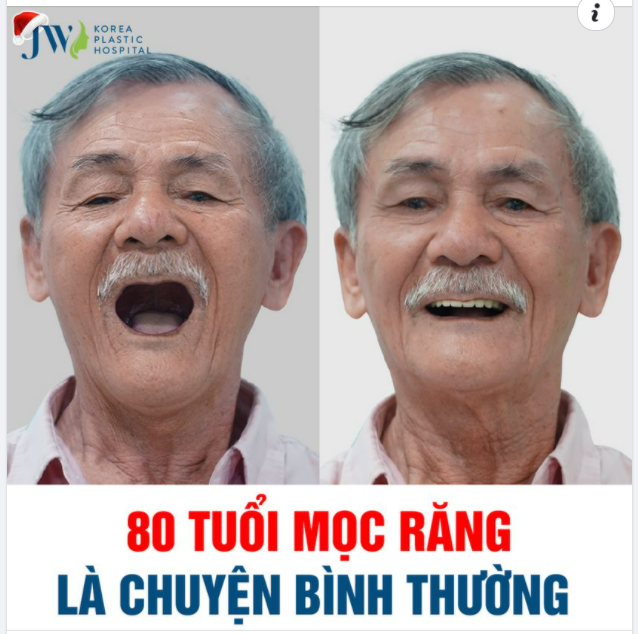 80 TUỔI MỌC RĂNG LÀ CHUYỆN BÌNH THƯỜNG