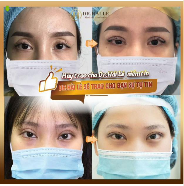“Ăn quả đắng" khi cắt mí tại cơ sở thiếu uy tín - Khách hàng tới đâu để khắc phục và thời gian nào là thời điểm vàng!