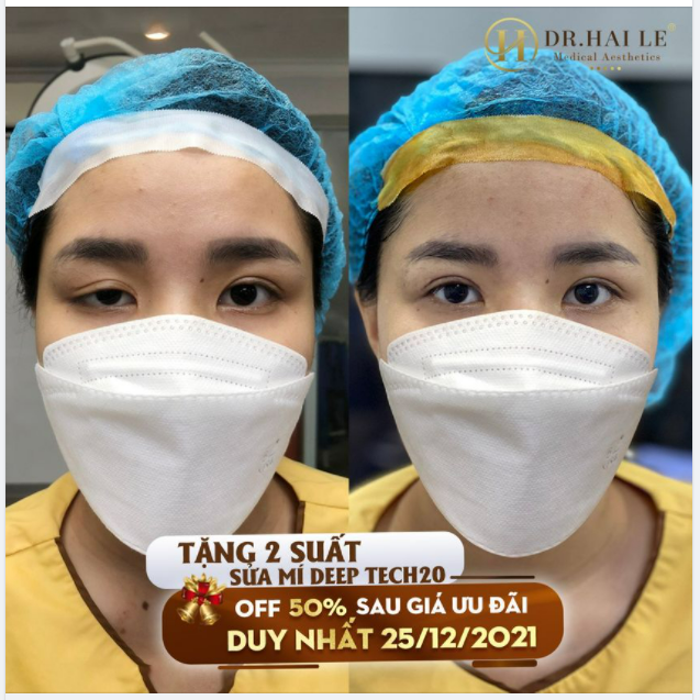 BẠN CÓ BIẾT: Một lần thẩm mỹ hỏng đồng nghĩa với cơ hội hoàn thiện vẻ đẹp mong ước của bạn giảm đi rất nhiều lần.