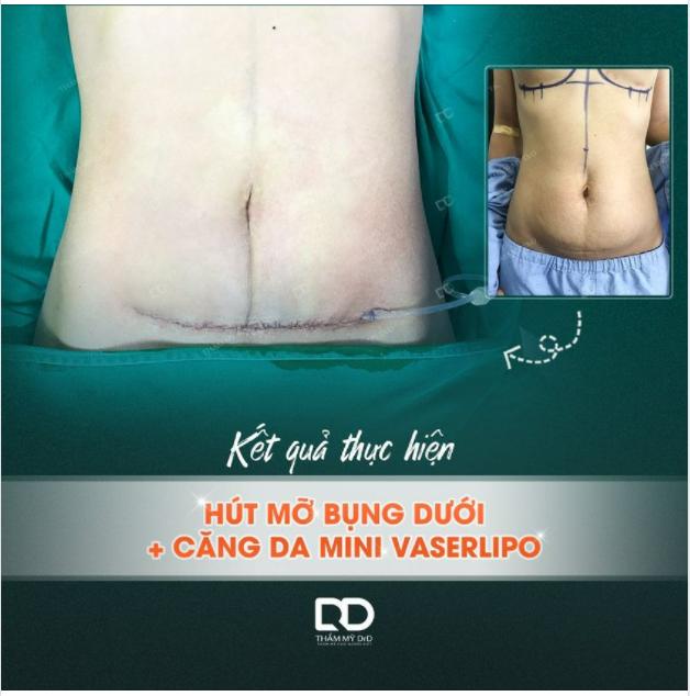 Bạn có biết: Tại sao đường phẫu thuật căng da bụng mini lại ngắn hơn so với tạo hình thành bụng không?