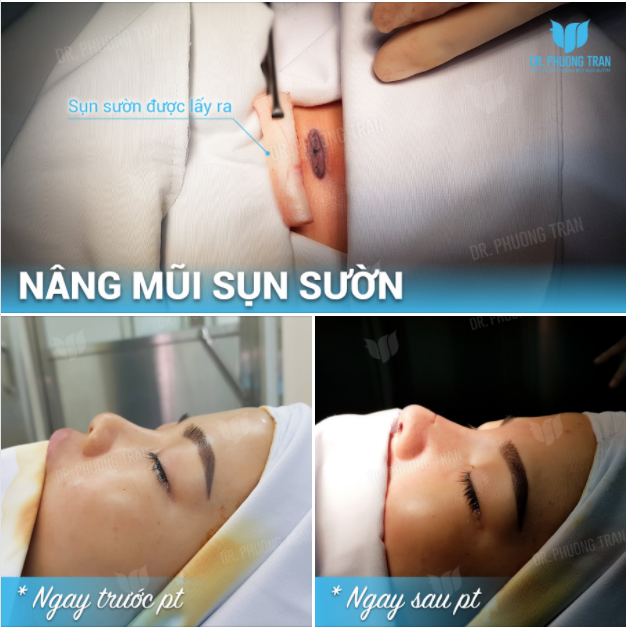 “BIẾN HÌNH” hoàn hảo nhờ nâng mũi sụn sườn