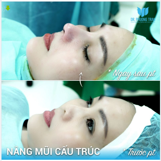 CA NÂNG MŨI CẤU TRÚC ĐẸP ĐẾN NAO LÒNG