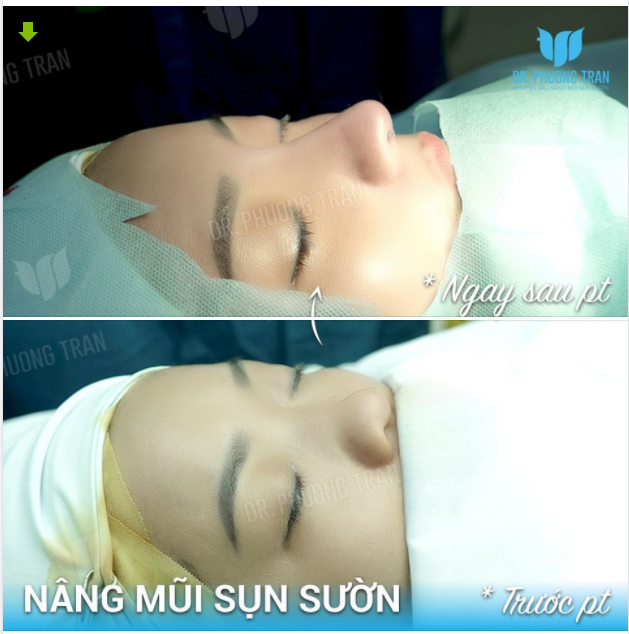CA SỤN SƯỜN ĐẦU NGÀY QUÁ ĐỈNH