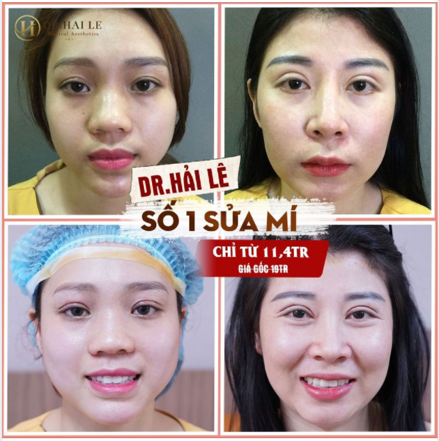Các ca sửa mí lỗi hỏng "thành công xuất sắc" tại Dr.Hải Lê được khách hàng khen ngợi hết lời!