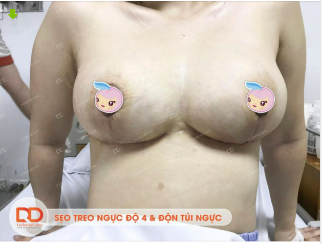 Các nàng có tò mò về đường sẹo sau treo ngực độ 4 và kết hợp độn túi ngực không ạ?