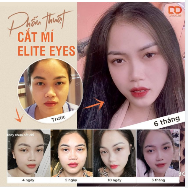 Cắt mí bao lâu thì hồi phục?