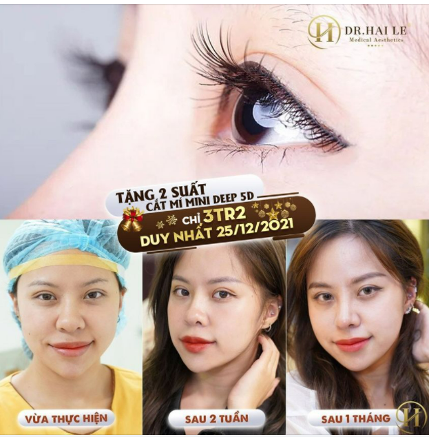CẮT MÍ DR.HẢI LÊ - CẮT MÍ MỘT LẦN, "MẮT BIẾC" TRỌN ĐỜI.!!