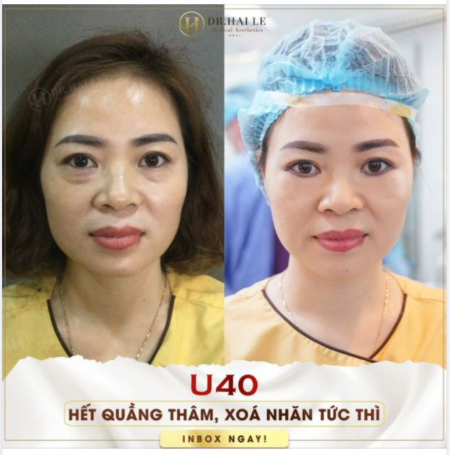 CẮT MÍ DƯỚI - Loại bỏ mỡ thừa, da chùng! CHỈ sau 30 Phút thực hiện!
