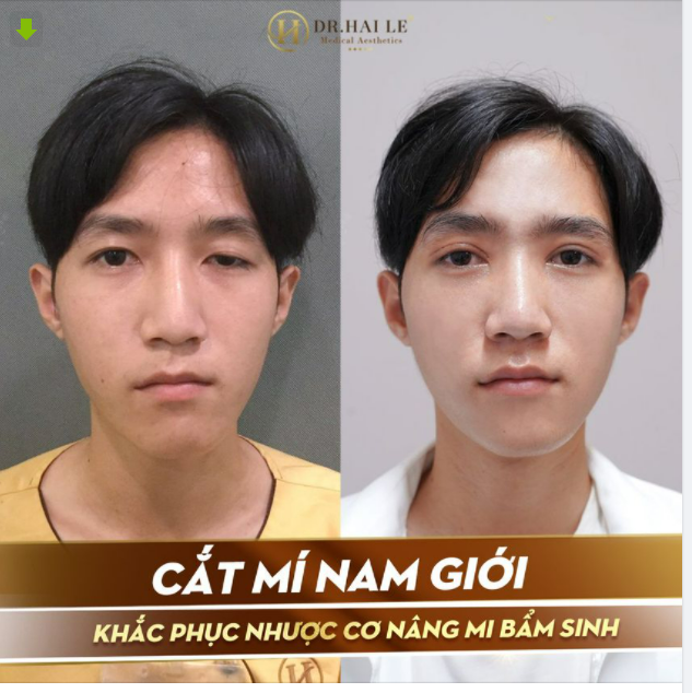 Cắt Mí Khắc Phục Nhược Cơ Bẩm Sinh Cho Khách Hàng Nam Giới Thách Thức