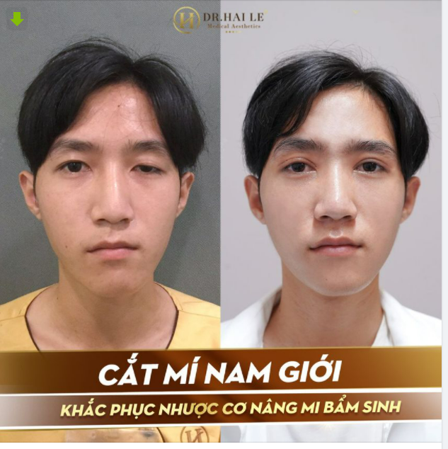 Cắt mí khắc phục nhược cơ bẩm sinh cho khách hàng Nam Giới - Thách thức mọi ca thẩm mỹ mắt phức tạp !
