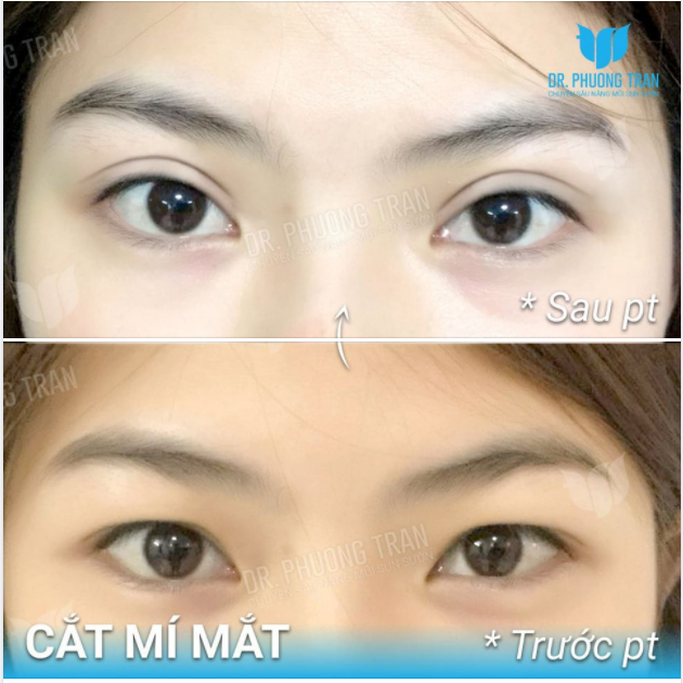 CẮT MÍ: KỸ THUẬT TẠO MẮT 2 MÍ ĐẸP TỰ NHIÊN CHỈ 15 PHÚT