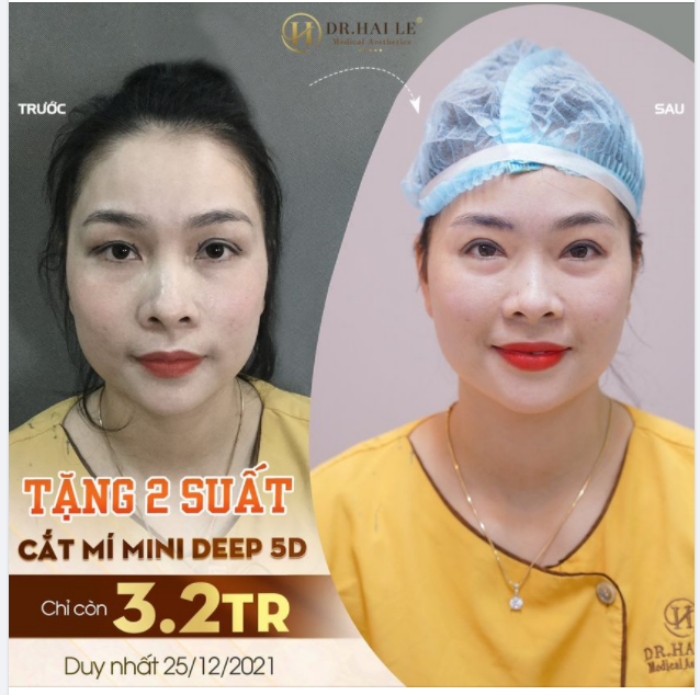 CẮT MÍ TẠI VTM DR.HẢI LÊ - CHỈ “SIÊU MẢNH” KHÔNG ĐỂ LẠI SẸO - ĐẸP NGAY SAU KHI LÀM.
