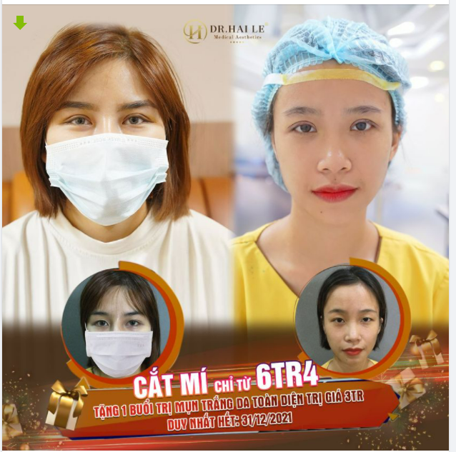 CẮT MÍ THẨM MỸ - DR.HẢI LÊ SỐ 1!
