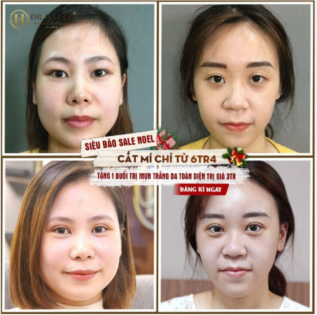CẮT MÍ THẨM MỸ - MỘT TIỂU PHẪU NHỎ, MỘT THAY ĐỔI LỚN!