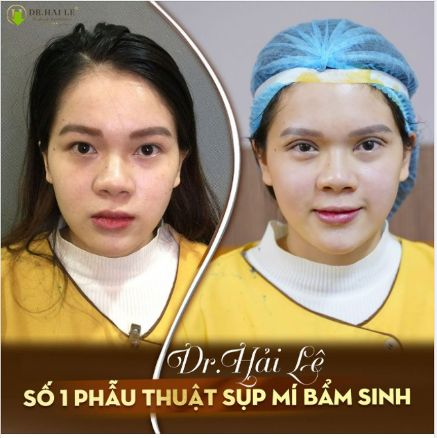 CẮT MÍ THẨM MỸ Khắc phục tình trạng sụp mí, mí lót